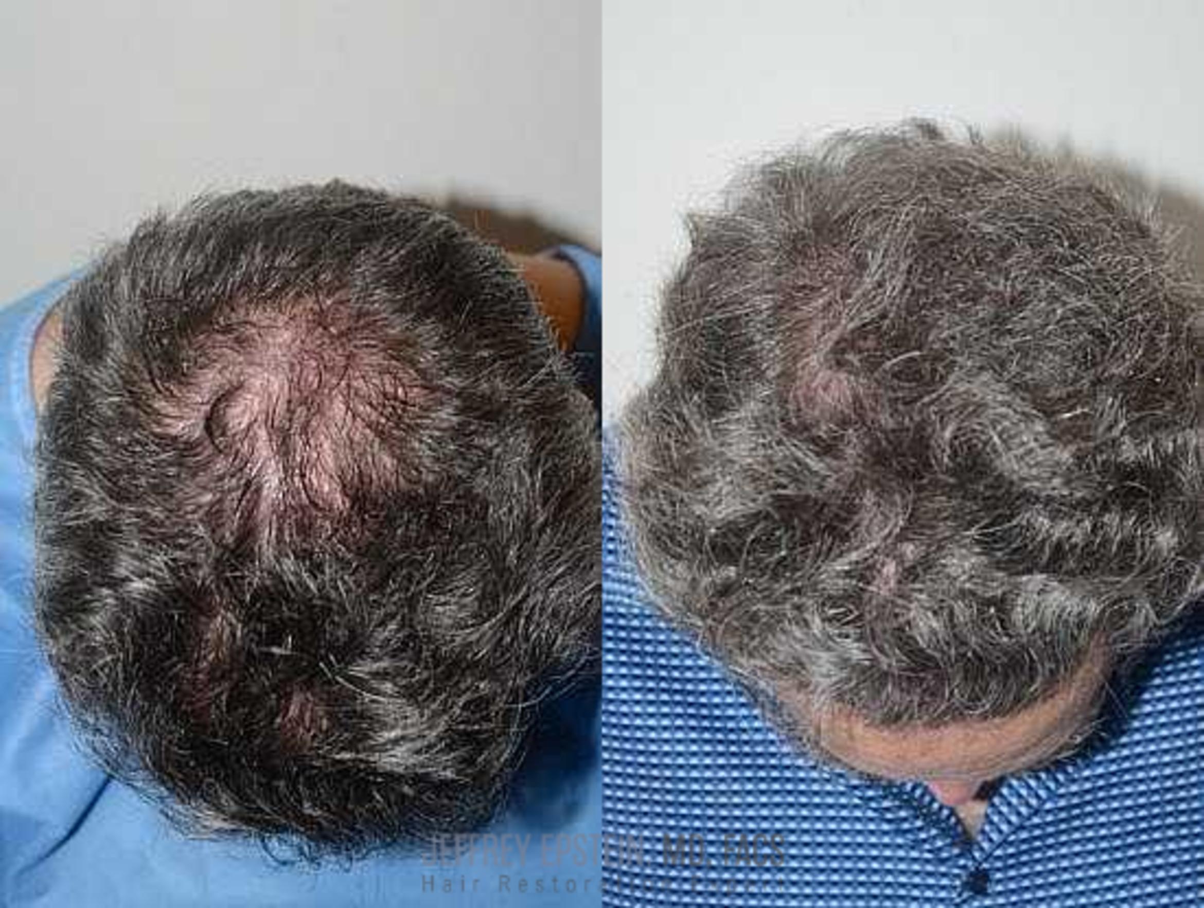 Before & After Hair Transplants For Men Case 54 View 2 View in Miami, FL