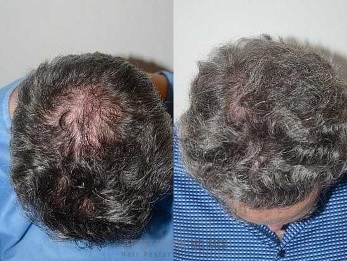 Before & After Hair Transplants For Men Case 54 View 2 View in Miami, FL