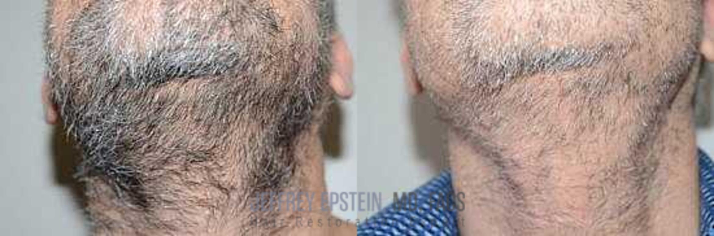 Before & After Hair Transplants For Men Case 54 View 3 View in Miami, FL