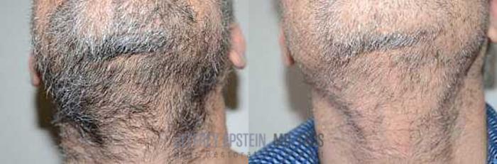 Before & After Hair Transplants For Men Case 54 View 3 View in Miami, FL