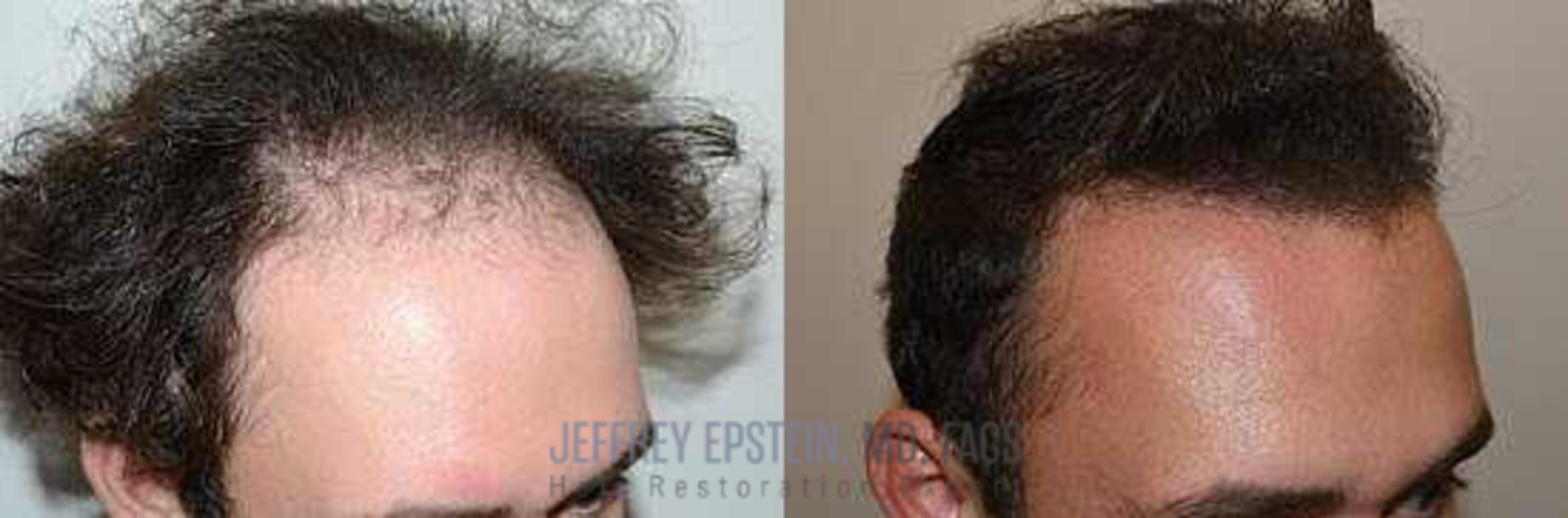 Before & After Hair Transplants For Men Case 55 View 1 View in Miami, FL