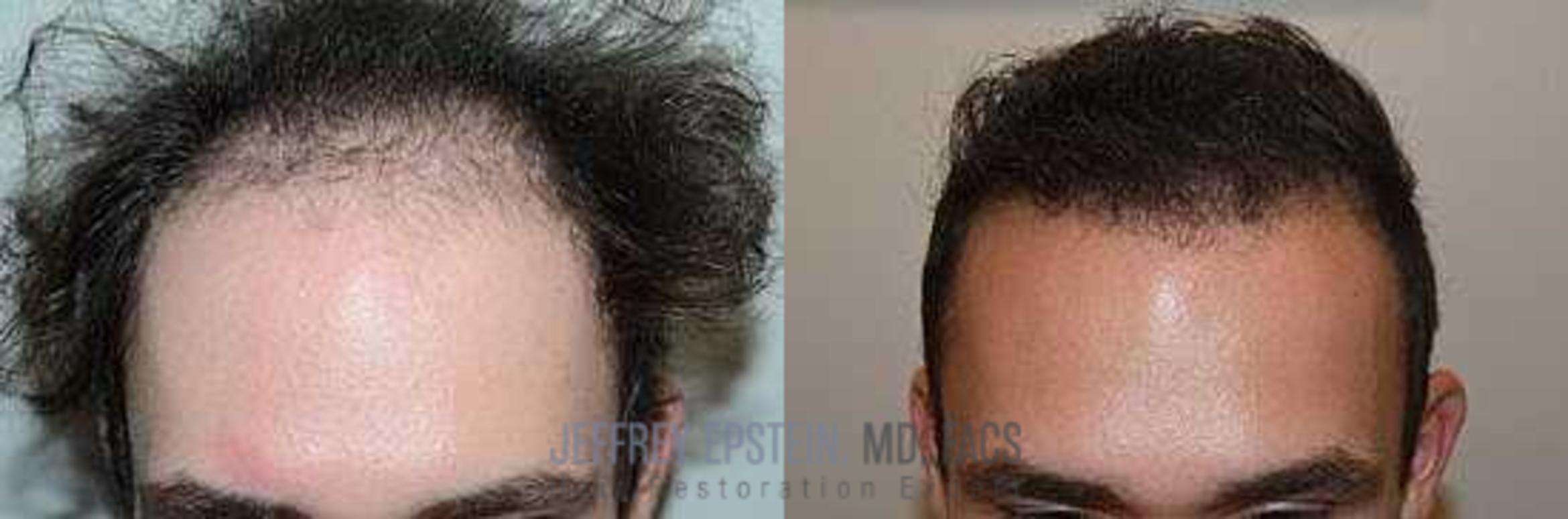 Before & After Hair Transplants For Men Case 55 View 2 View in Miami, FL
