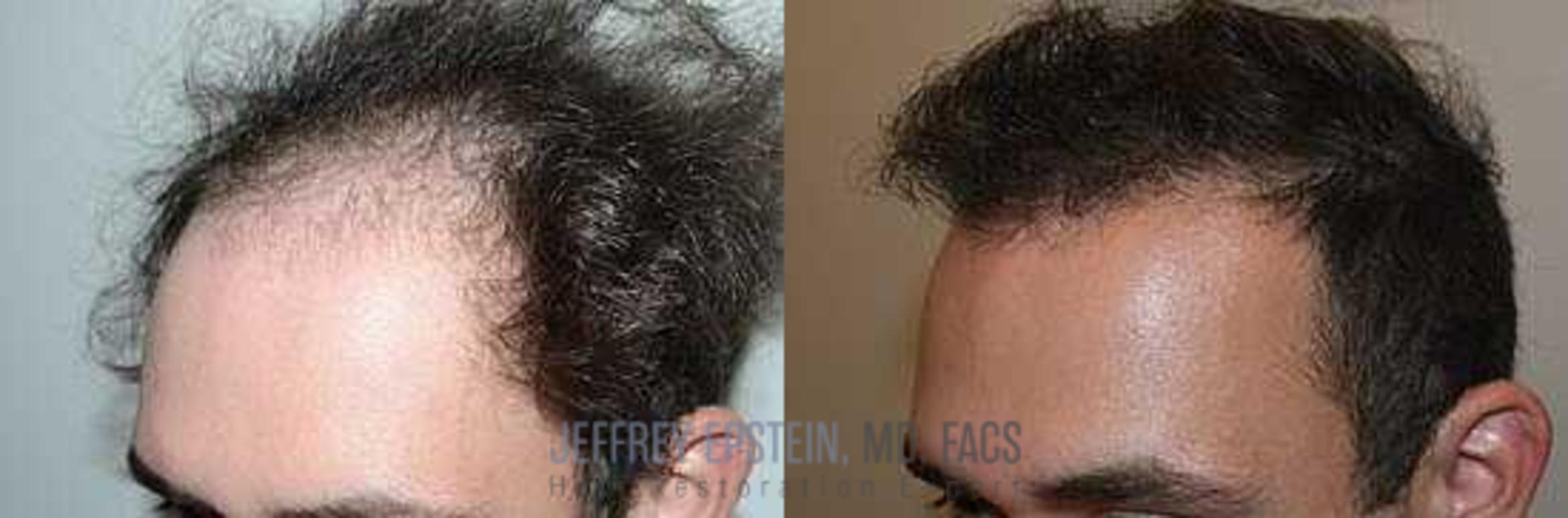 Before & After Hair Transplants For Men Case 55 View 3 View in Miami, FL