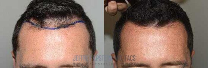 Before & After Hair Transplants For Men Case 56 View 1 View in Miami, FL