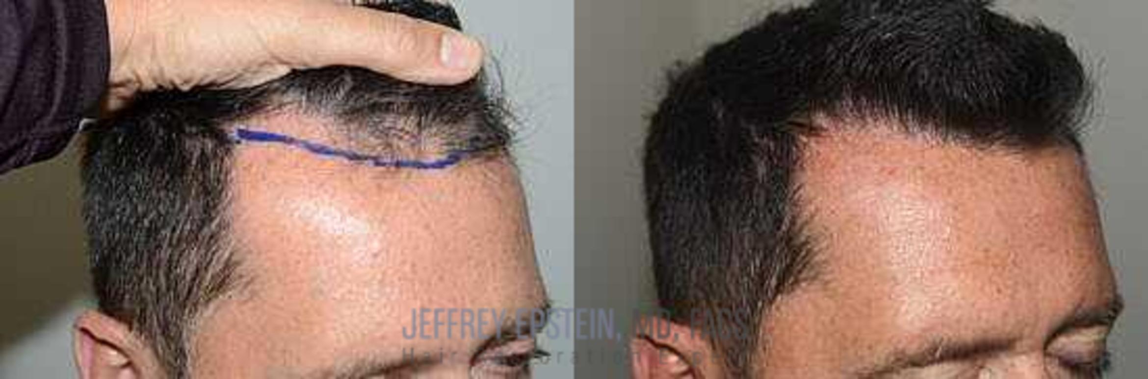 Before & After Hair Transplants For Men Case 56 View 2 View in Miami, FL