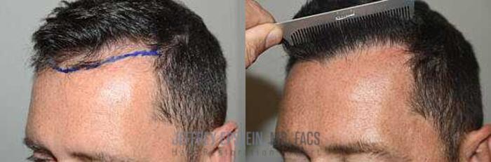 Before & After Hair Transplants For Men Case 56 View 3 View in Miami, FL