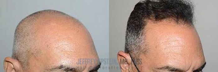 Before & After Hair Transplants For Men Case 57 View 1 View in Miami, FL