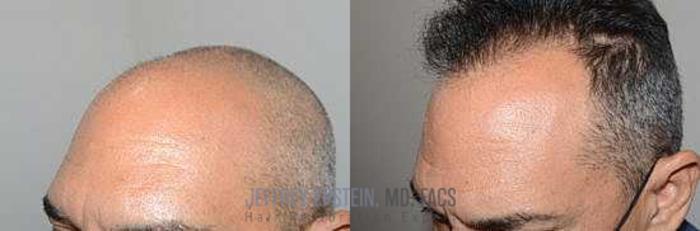 Before & After Hair Transplants For Men Case 57 View 2 View in Miami, FL