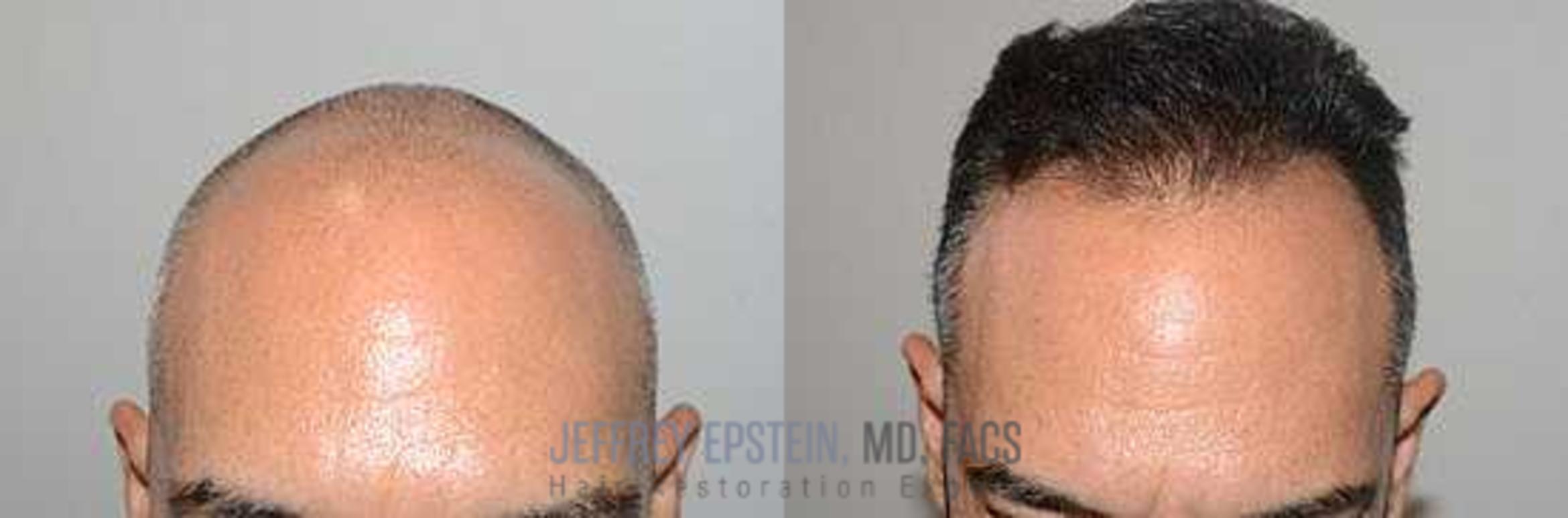 Before & After Hair Transplants For Men Case 57 View 3 View in Miami, FL