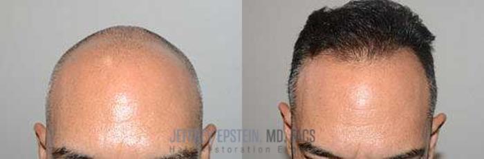 Before & After Hair Transplants For Men Case 57 View 3 View in Miami, FL