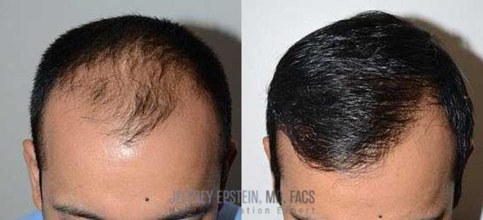 Before & After Hair Transplants For Men Case 58 View 1 View in Miami, FL