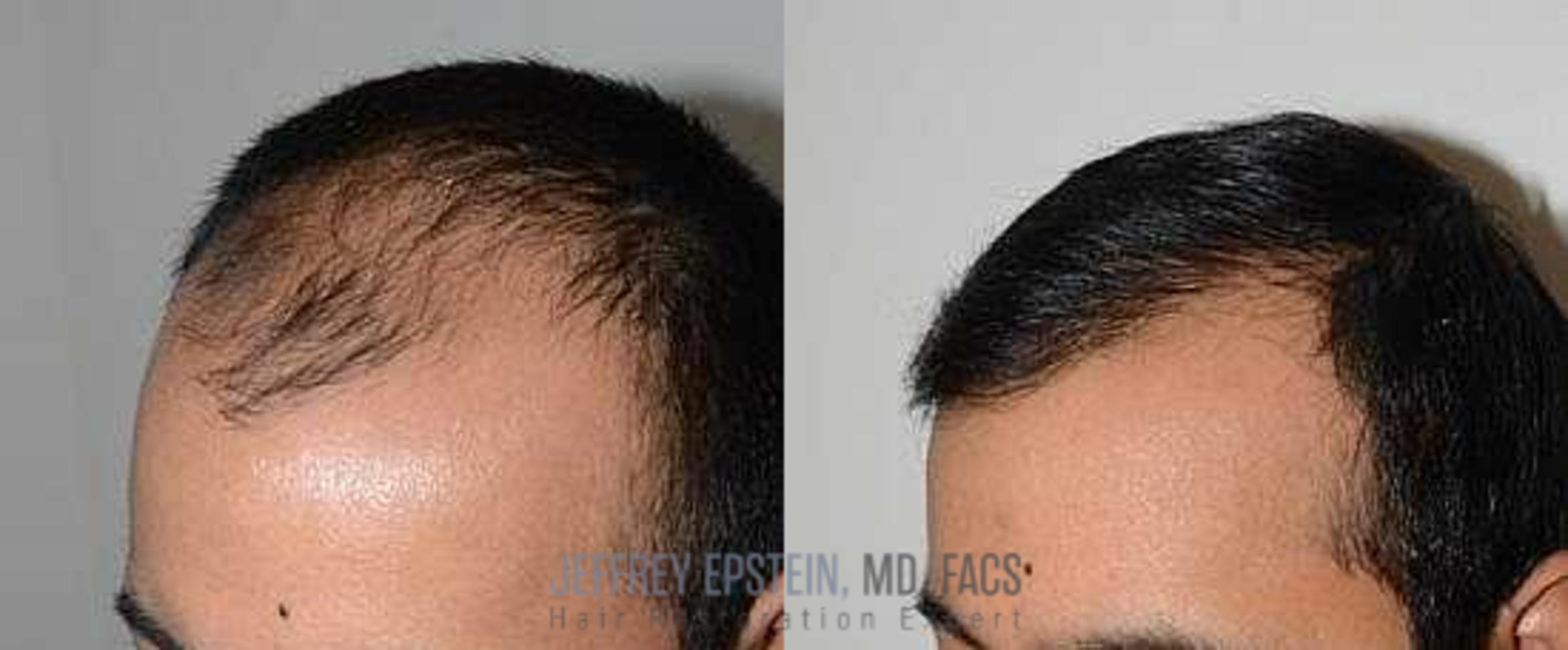 Before & After Hair Transplants For Men Case 58 View 2 View in Miami, FL