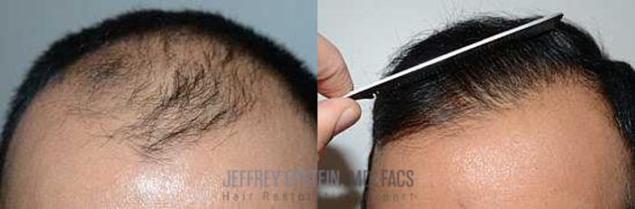 Before & After Hair Transplants For Men Case 58 View 3 View in Miami, FL