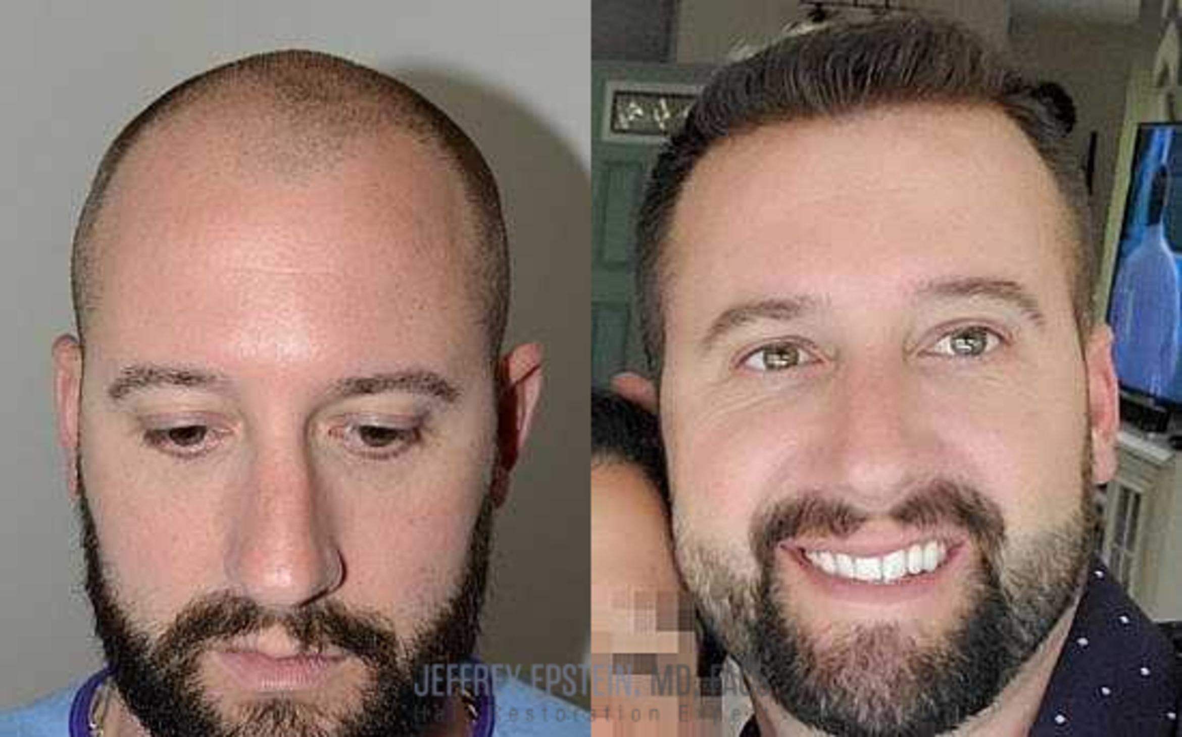 Before & After Hair Transplants For Men Case 59 View 1 View in Miami, FL