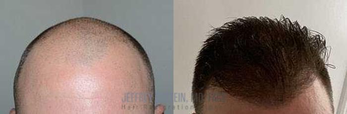 Before & After Hair Transplants For Men Case 59 View 2 View in Miami, FL