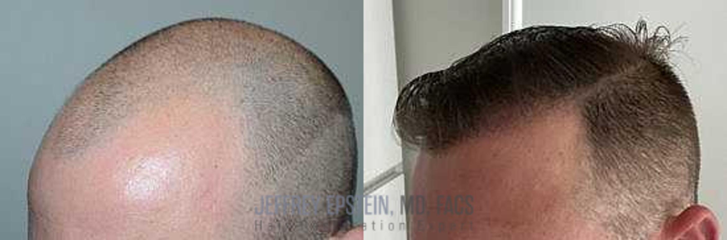 Before & After Hair Transplants For Men Case 59 View 3 View in Miami, FL