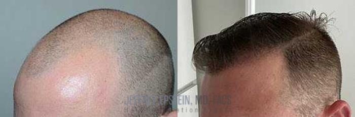 Before & After Hair Transplants For Men Case 59 View 3 View in Miami, FL