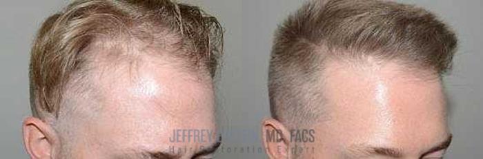 Before & After Hair Transplants For Men Case 6 View 2 View in Miami, FL