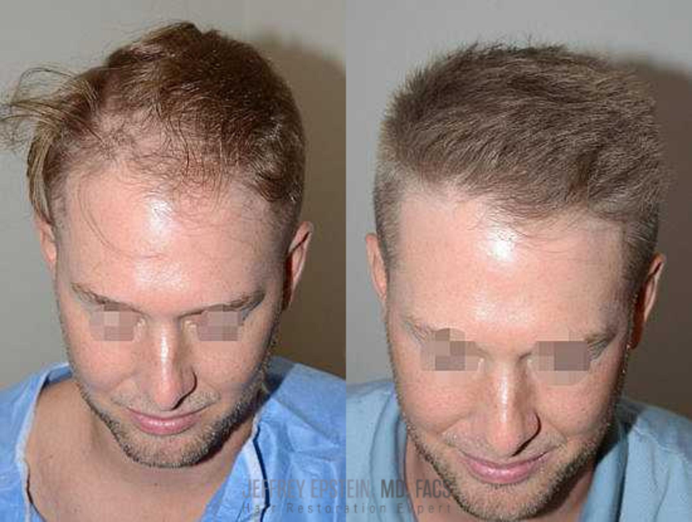 Before & After Hair Transplants For Men Case 6 View 3 View in Miami, FL