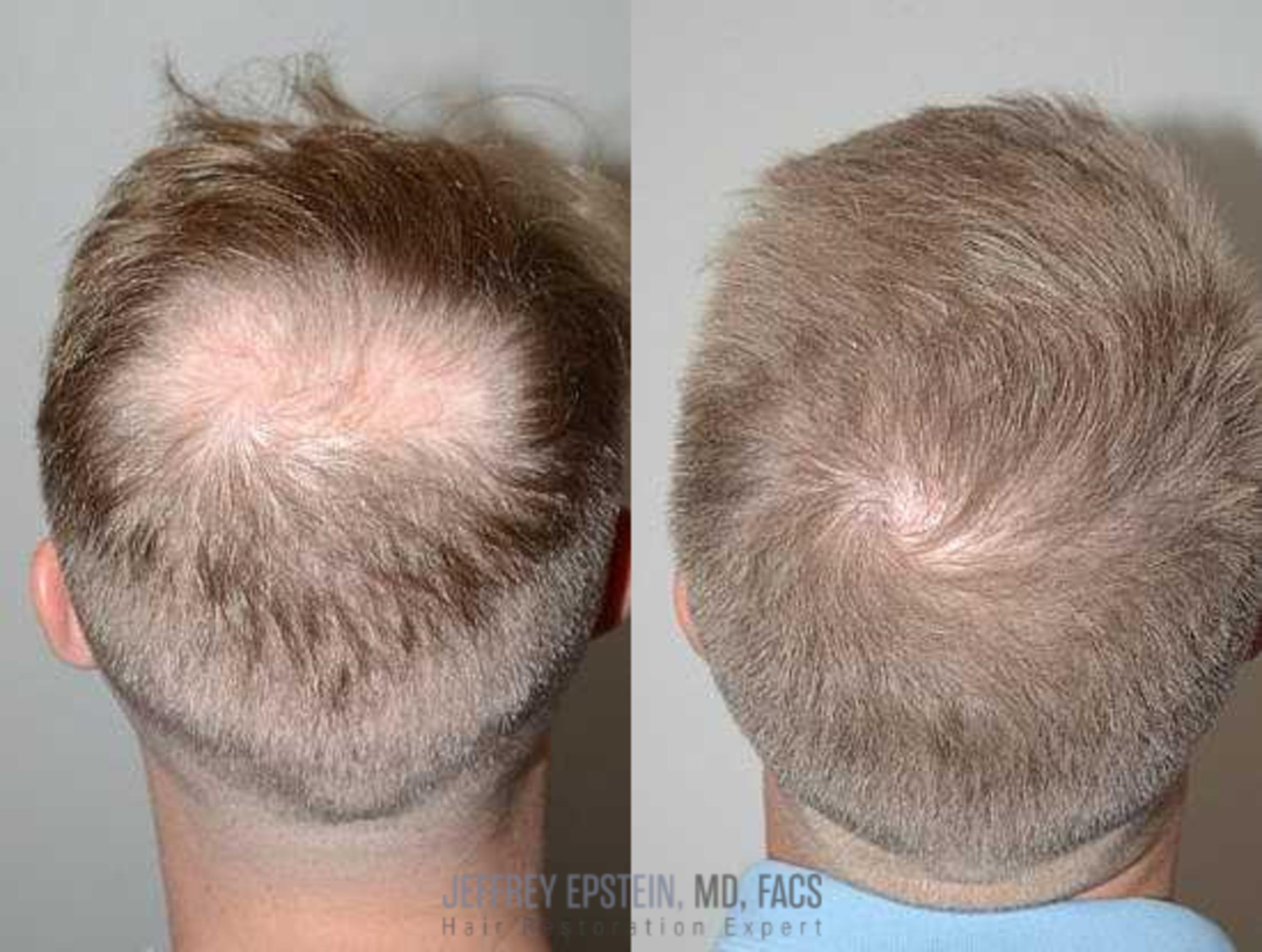 Before & After Hair Transplants For Men Case 6 View 4 View in Miami, FL