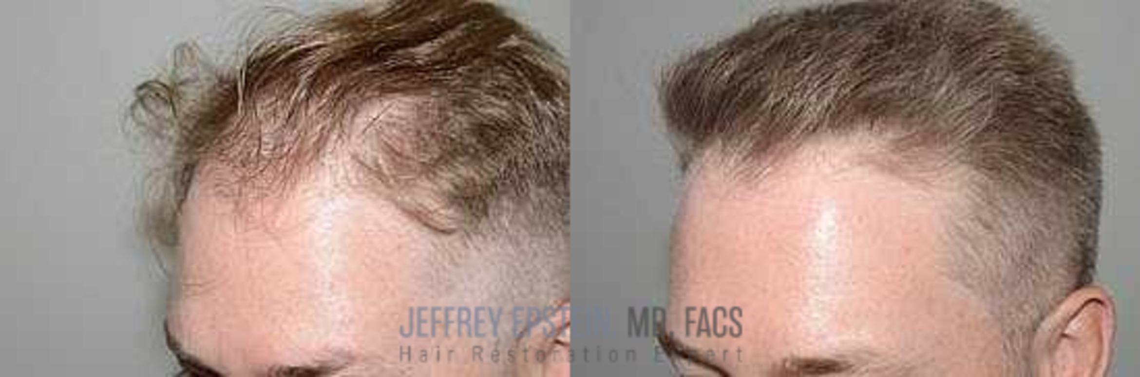 Before & After Hair Transplants For Men Case 6 View 5 View in Miami, FL