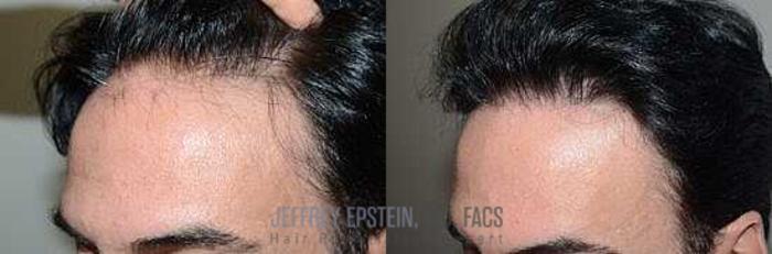 Before & After Hair Transplants For Men Case 61 View 1 View in Miami, FL