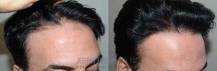 Before & After Hair Transplants For Men Case 61 View 2 View in Miami, FL