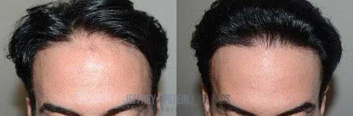 Before & After Hair Transplants For Men Case 61 View 3 View in Miami, FL