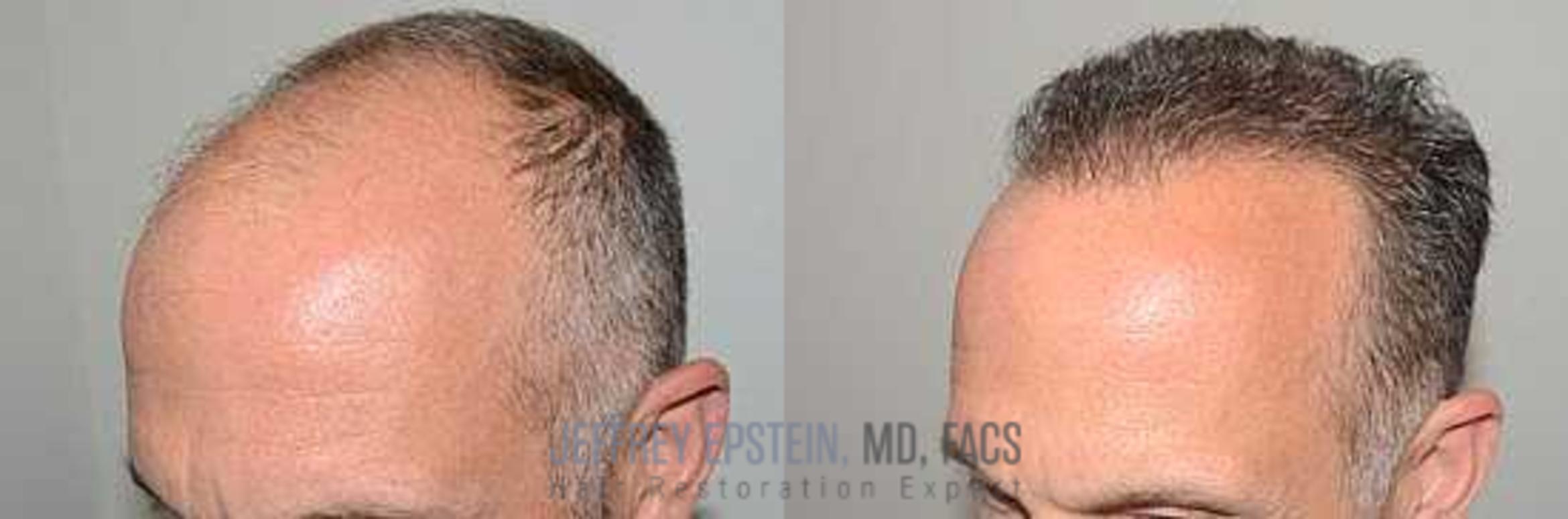 Before & After Hair Transplants For Men Case 63 View 1 View in Miami, FL