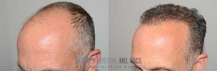 Before & After Hair Transplants For Men Case 63 View 1 View in Miami, FL