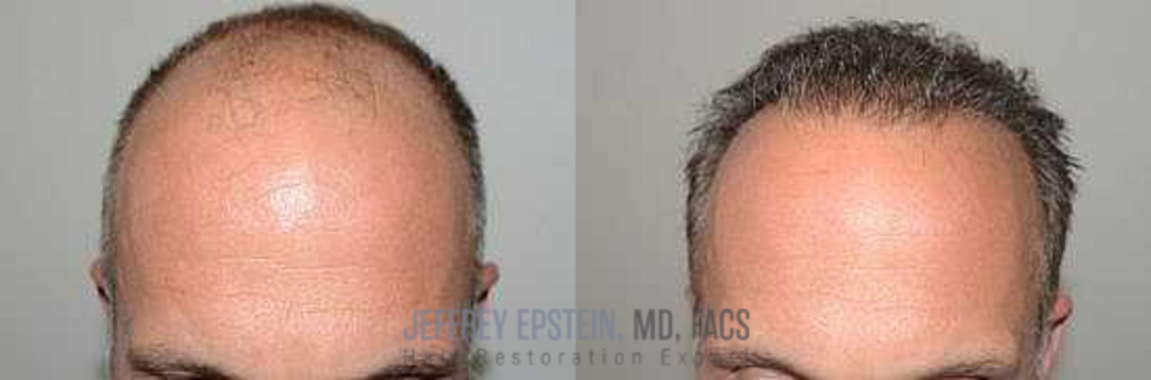 Before & After Hair Transplants For Men Case 63 View 2 View in Miami, FL