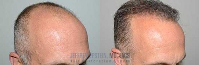 Before & After Hair Transplants For Men Case 63 View 3 View in Miami, FL