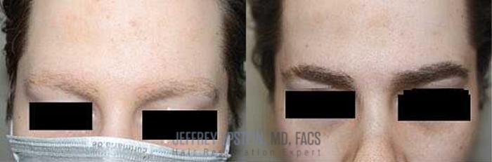 Before & After Hair Transplants For Men Case 64 View 1 View in Miami, FL