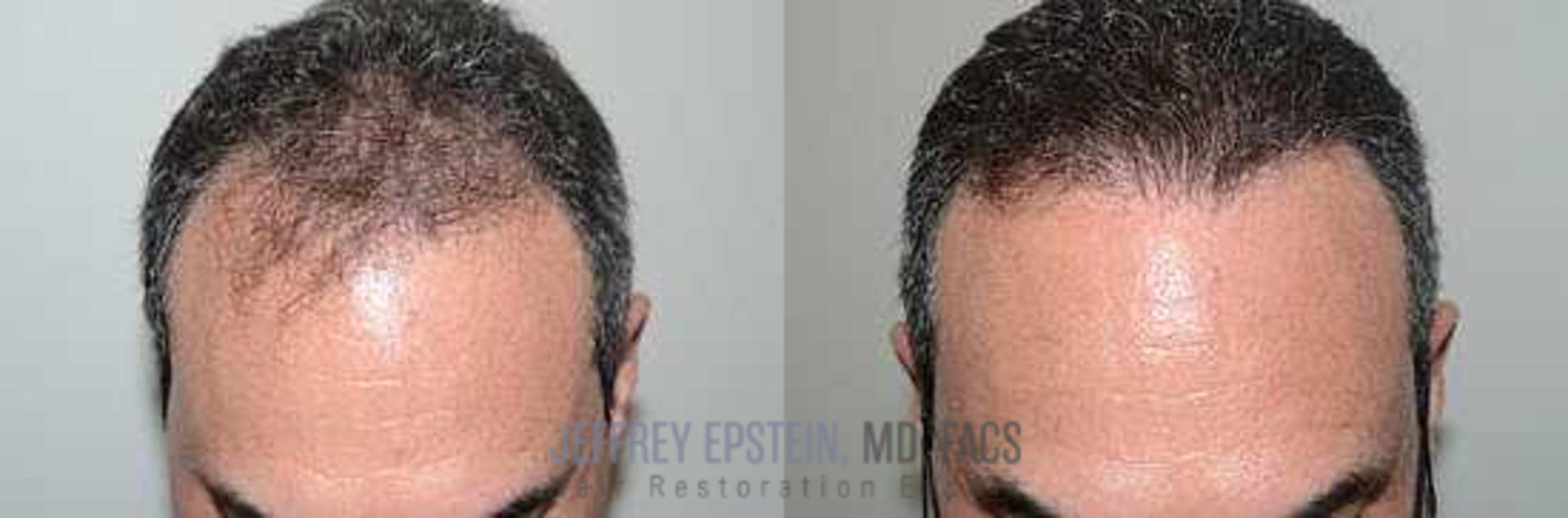 Before & After Hair Transplants For Men Case 65 View 1 View in Miami, FL