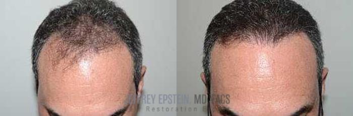Before & After Hair Transplants For Men Case 65 View 1 View in Miami, FL