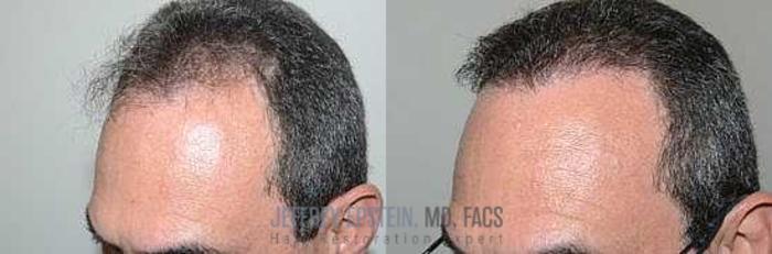 Before & After Hair Transplants For Men Case 65 View 2 View in Miami, FL