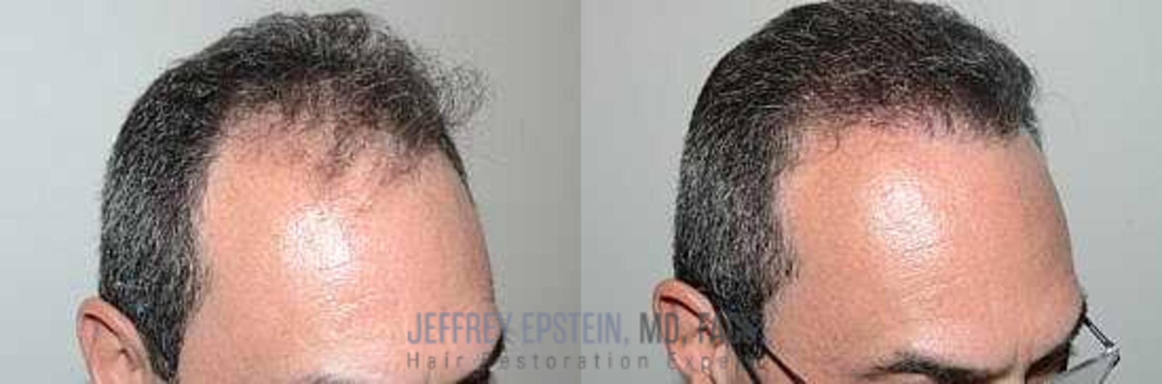 Before & After Hair Transplants For Men Case 65 View 3 View in Miami, FL