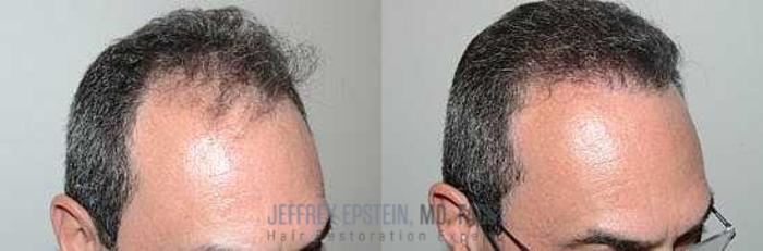 Before & After Hair Transplants For Men Case 65 View 3 View in Miami, FL