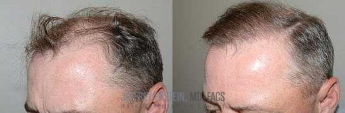 Before & After Hair Transplants For Men Case 66 View 1 View in Miami, FL