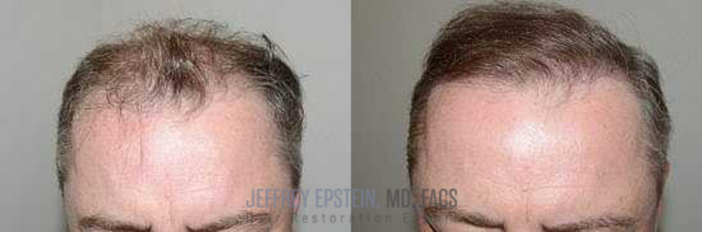 Before & After Hair Transplants For Men Case 66 View 2 View in Miami, FL