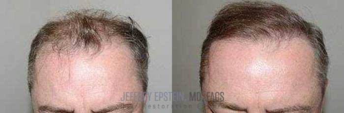Before & After Hair Transplants For Men Case 66 View 2 View in Miami, FL