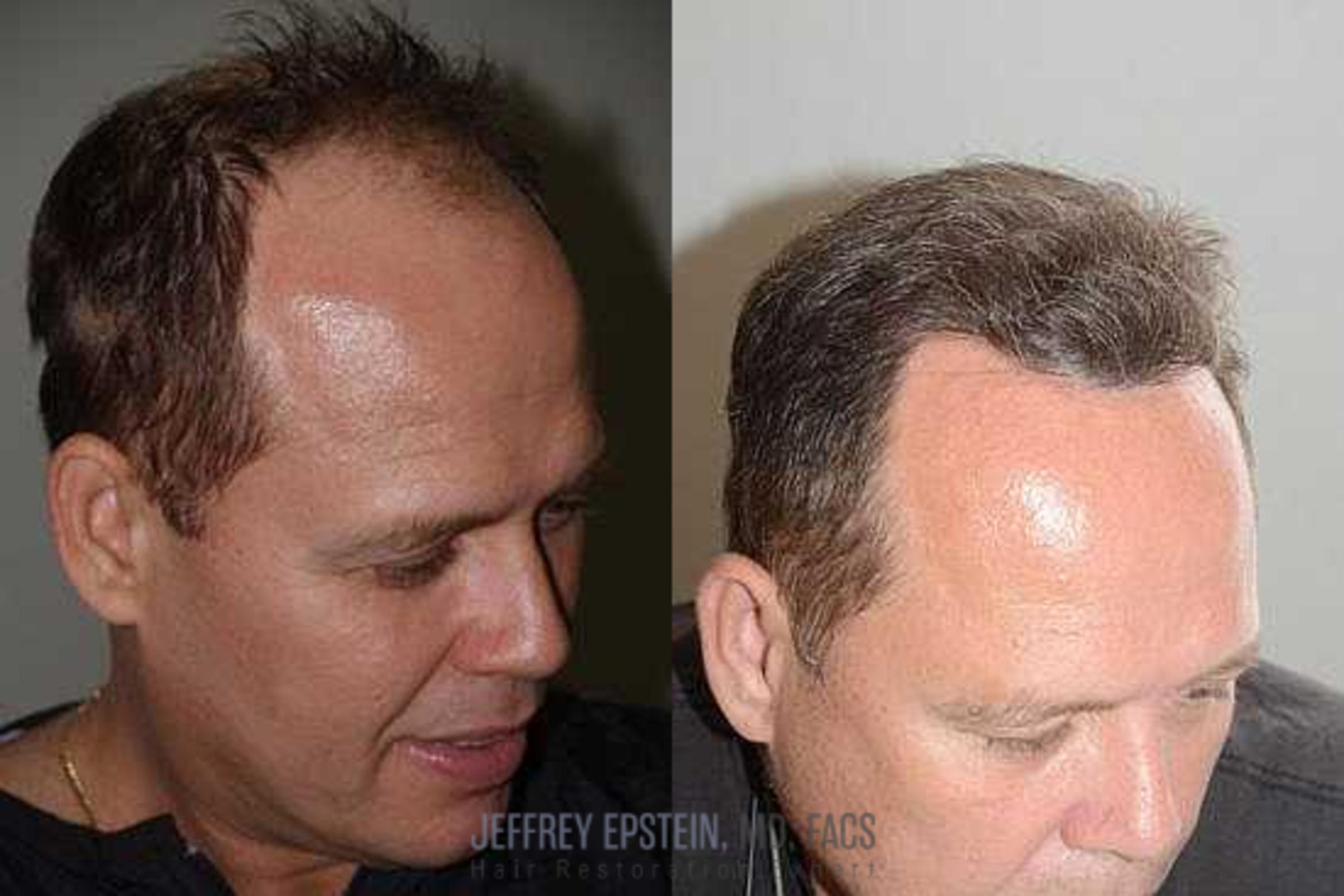 Before & After Hair Transplants For Men Case 67 View 1 View in Miami, FL