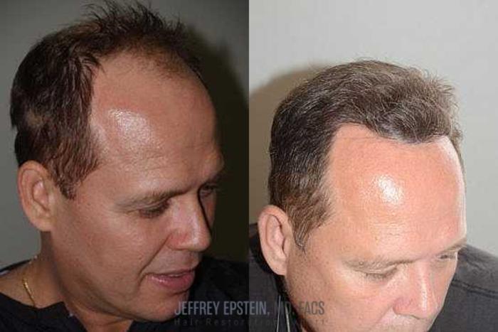 Before & After Hair Transplants For Men Case 67 View 1 View in Miami, FL