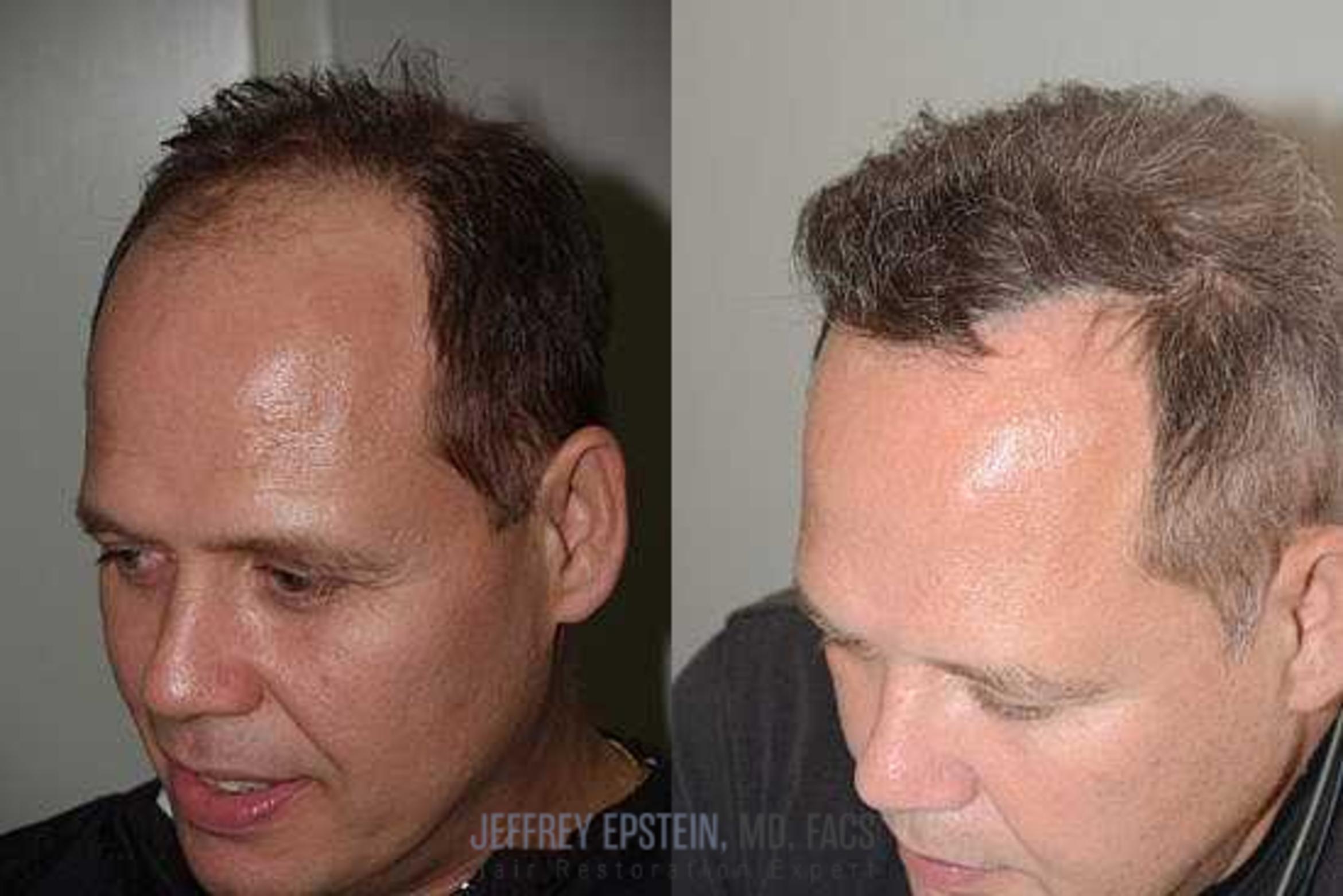 Before & After Hair Transplants For Men Case 67 View 2 View in Miami, FL