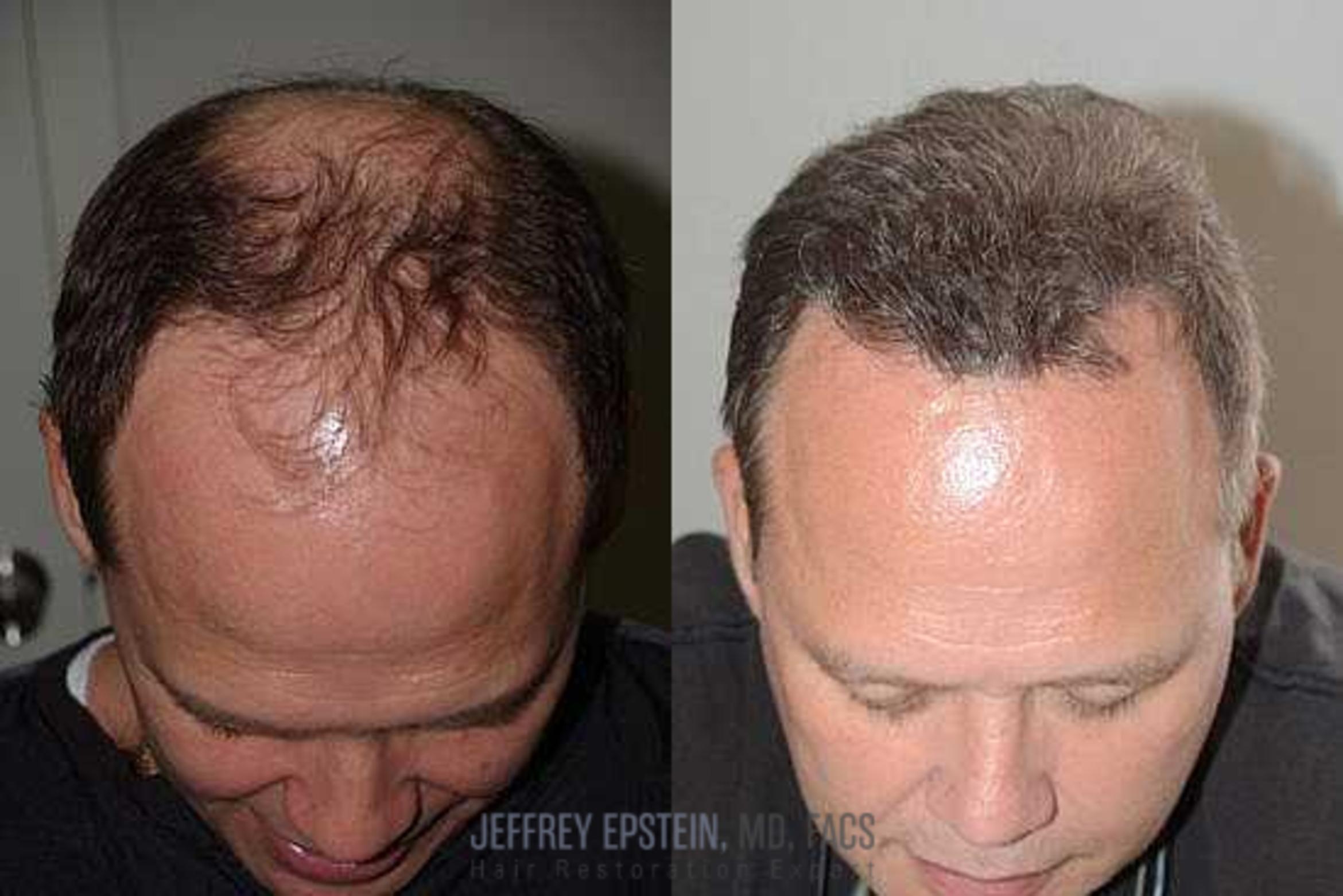 Before & After Hair Transplants For Men Case 67 View 3 View in Miami, FL