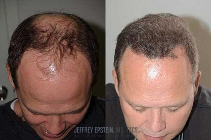 Before & After Hair Transplants For Men Case 67 View 3 View in Miami, FL