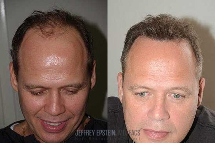 Before & After Hair Transplants For Men Case 67 View 4 View in Miami, FL