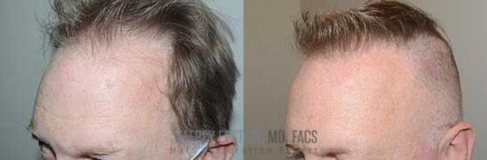 Before & After Hair Transplants For Men Case 68 View 1 View in Miami, FL