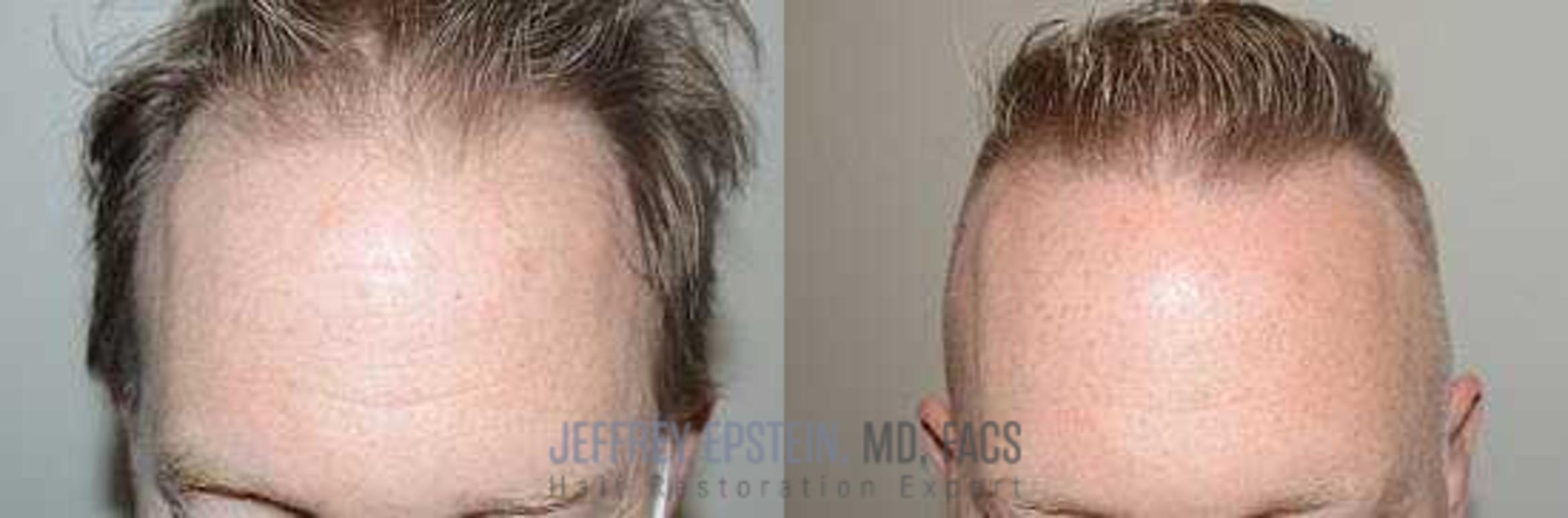 Before & After Hair Transplants For Men Case 68 View 2 View in Miami, FL
