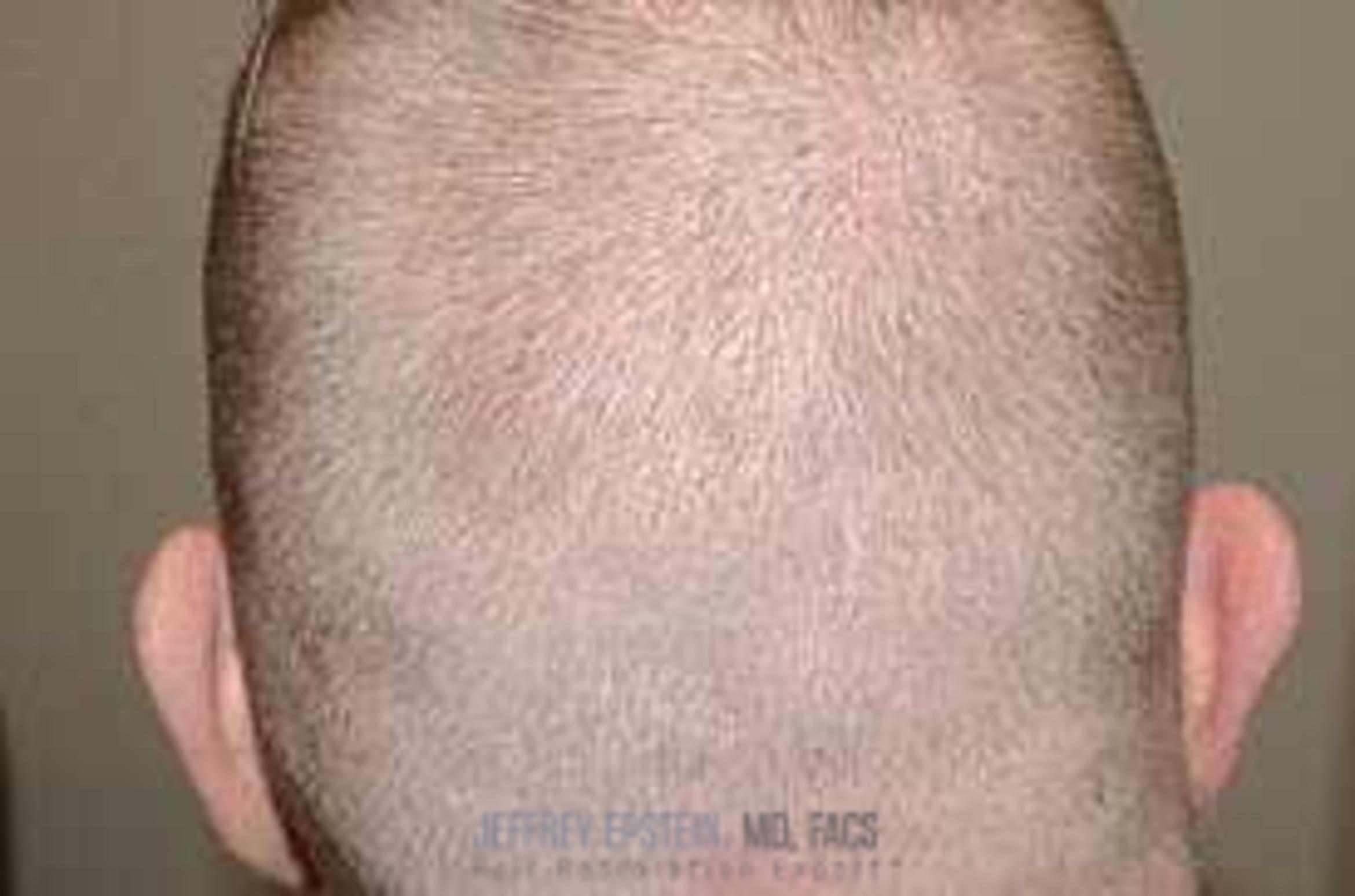 Before & After Hair Transplants For Men Case 68 View 3 View in Miami, FL